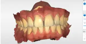 Nua Clinica Dental - Escáner intraoral