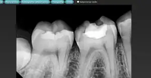 Nua Clinica Dental - Radiografía periapical