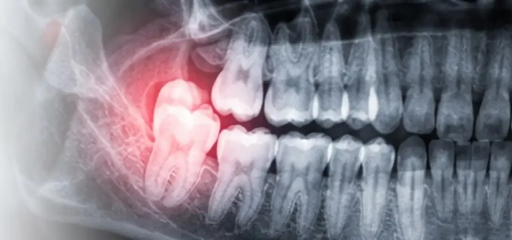 Extracción de muela del juicio - Nua Clínica Dental