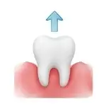 Extracción de muelas - Nua Clinica Dental