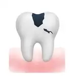Extracción de muelas con caries - Nua Clinica Dental