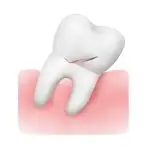 Extracción de muelas del juicio - Nua Clinica Dental