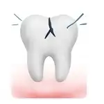 Extracción de muelas fracturadas - Nua Clinica Dental
