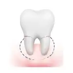Extracción de muelas y restos radiculares - Nua Clinica Dental